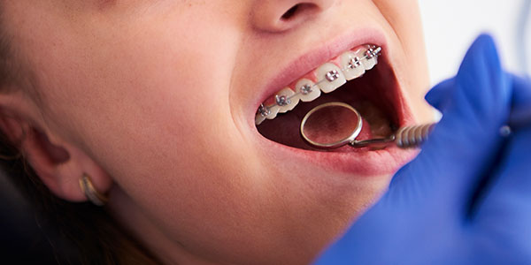 Ortodoncia con brackets para niños en Albacete