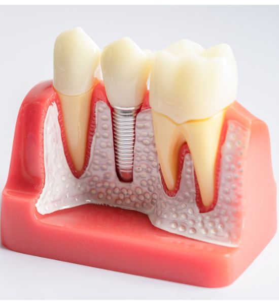 Implantes dentales albacete Implantes dentales albacete
