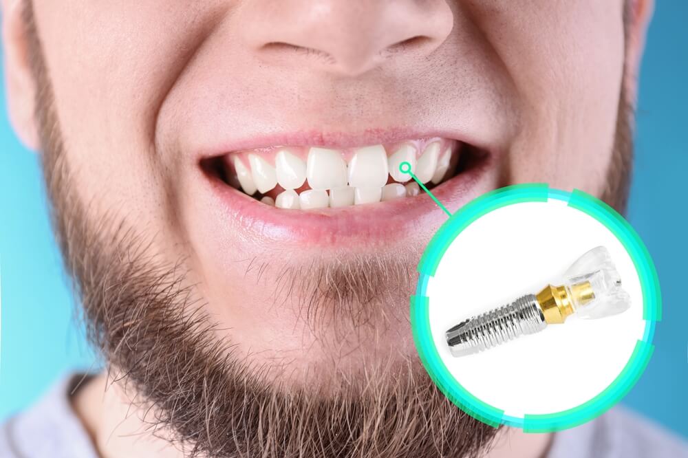 ¿Se Puede Llevar Ortodoncia Si Se Tiene Implantes? | - Clínica Dental ...